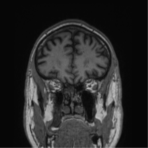 Alzheimer's disease- with Gerstmann syndrome and dressing apraxia (Radiopaedia 54882-61150 Coronal T1 70).png