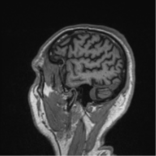 Alzheimer's disease- with Gerstmann syndrome and dressing apraxia (Radiopaedia 54882-61150 Sagittal T1 61).png