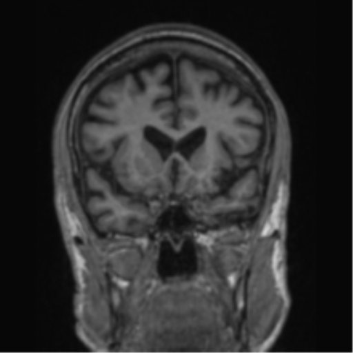 File:Alzheimer's disease- with apraxia (Radiopaedia 54763-61011 Coronal T1 63).png