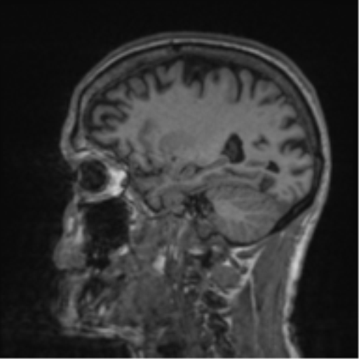 Alzheimer's disease- with apraxia (Radiopaedia 54763-61011 Sagittal T1 23).png