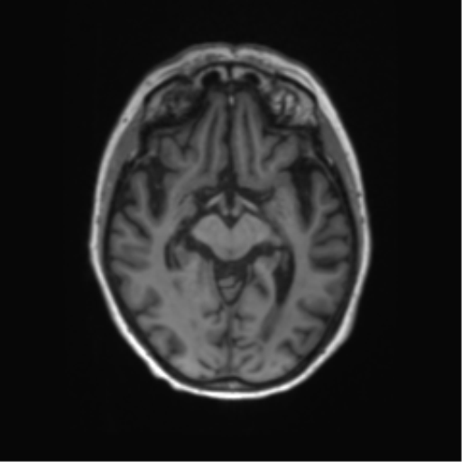 File:Alzheimer's disease (Radiopaedia 42658-45802 Axial T1 90).png