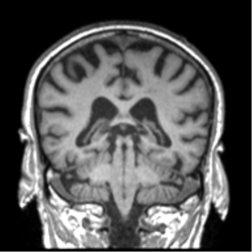 Alzheimer disease and cerebral amyloid angiopathy (Radiopaedia 64234-73011 Coronal T1 22).png