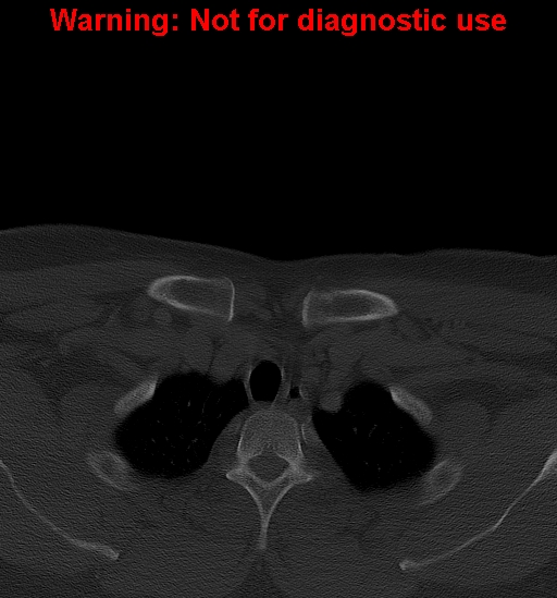 Ameloblastoma (Radiopaedia 33126-34164 Axial bone window 51).jpg