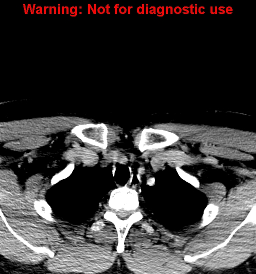 File:Ameloblastoma (Radiopaedia 33126-34164 B 48).jpg