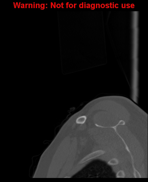Ameloblastoma (Radiopaedia 33126-34164 Sagittal bone window 4).jpg