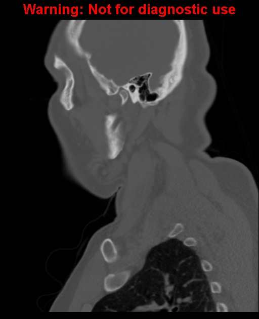 Ameloblastoma (Radiopaedia 33126-34164 Sagittal bone window 57).jpg