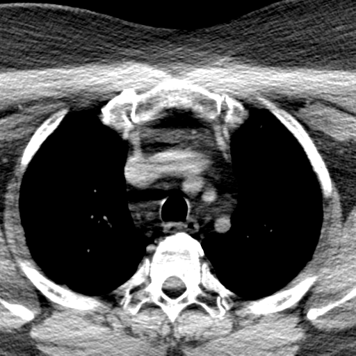 Ameloblastoma (Radiopaedia 38520-40623 Axial non-contrast 85).png
