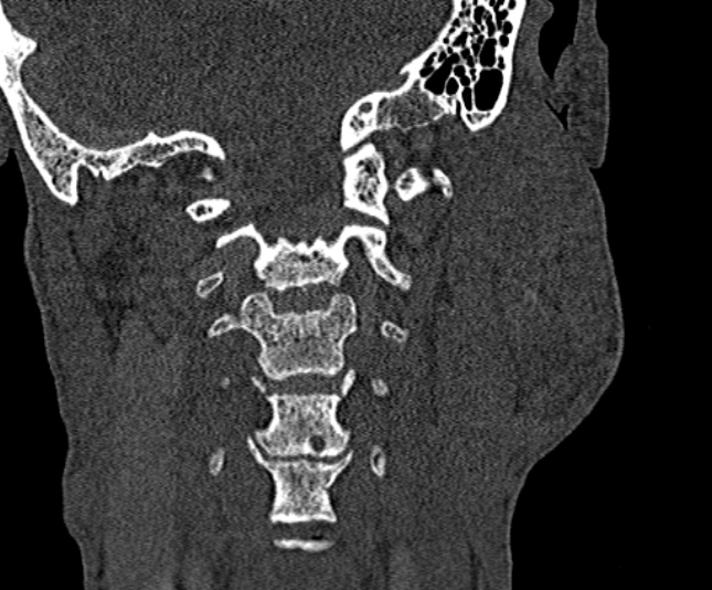 Ameloblastoma (Radiopaedia 51921-57766 Coronal bone window 239).jpg