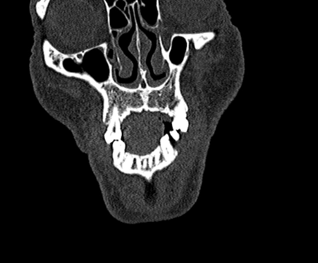 Ameloblastoma (Radiopaedia 51921-57766 Coronal bone window 32).jpg