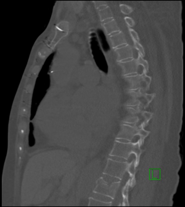 Amiodarone deposition in the liver (Radiopaedia 77587-89780 Sagittal bone window 51).jpg
