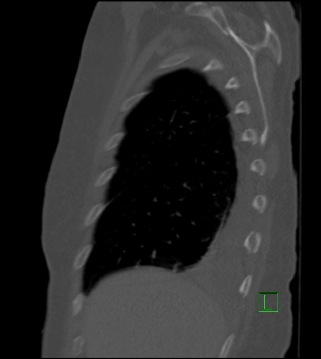 Amiodarone deposition in the liver (Radiopaedia 77587-89780 Sagittal bone window 80).jpg