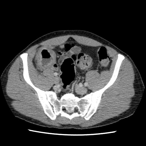 Amoebic liver abscesses (Radiopaedia 55536-62009 A 69).jpg