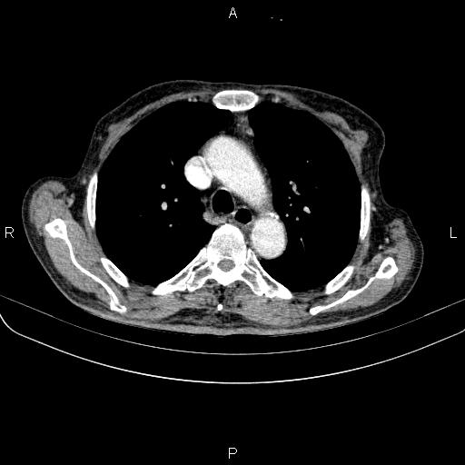 File:Ampullary adenocarcinoma (Radiopaedia 86093-102033 B 25).jpg