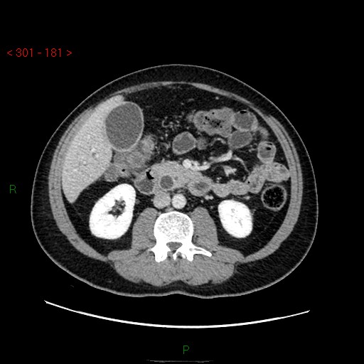 Ampullary carcinoma (Radiopaedia 56396-63056 C 48).jpg