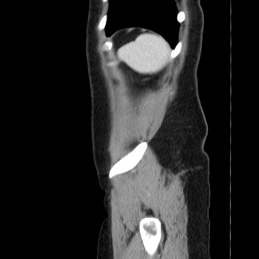 Ampullary tumor (Radiopaedia 22787-22816 D 51).jpg