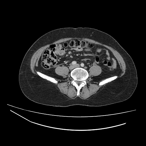 Ampullary tumor (Radiopaedia 60333-67998 A 55).jpg