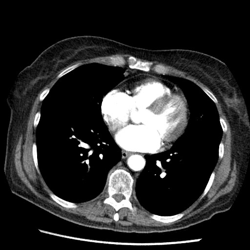 File:Amyloidosis - bronchial and diffuse nodular pulmonary involvement (Radiopaedia 60156-67745 A 34).jpg