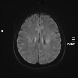 File:Amyotrophic lateral sclerosis (Radiopaedia 70821-81017 Axial DWI 10).jpg