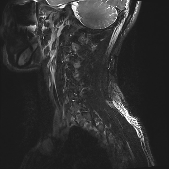 Amyotrophic lateral sclerosis (Radiopaedia 87352-103658 I 1).jpg