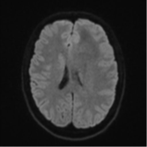 File:Anaplastic astrocytoma (Radiopaedia 57768-64731 Axial DWI 45).png