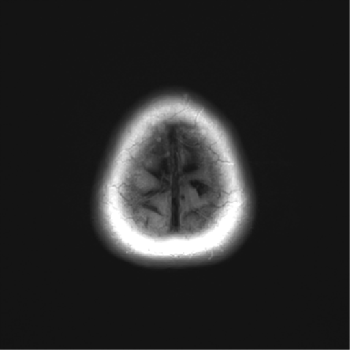 File:Anaplastic astrocytoma (Radiopaedia 86943-103160 Axial FLAIR 27).png