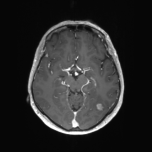 File:Anaplastic astrocytoma (Radiopaedia 86943-103160 Axial T1 C+ 16).png