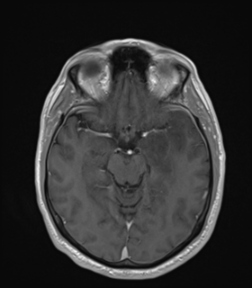 File:Anaplastic astrocytoma IDH wild-type (Radiopaedia 49984-55273 Axial T1 C+ 24).png