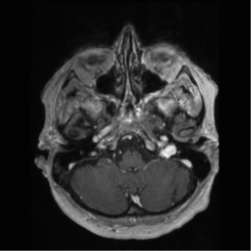 File:Anaplastic astrocytoma IDH wild-type (pseudoprogression) (Radiopaedia 42209-45277 Axial T1 C+ 20).png