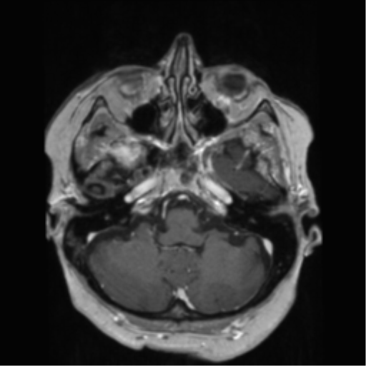 File:Anaplastic astrocytoma IDH wild-type (pseudoprogression) (Radiopaedia 42209-45278 Axial T1 C+ 43).png