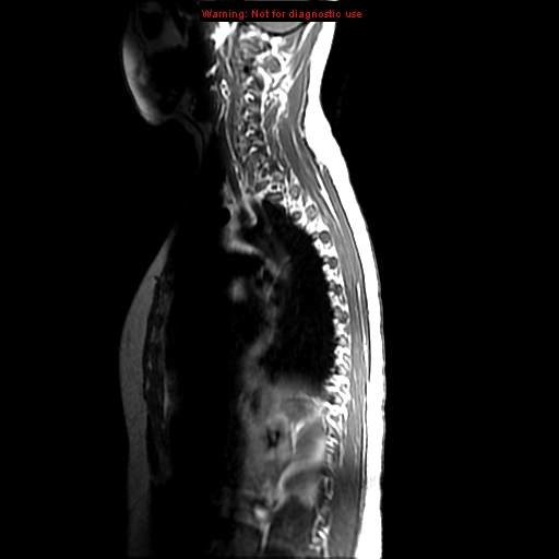 File:Aneurysmal bone cyst (Radiopaedia 9419-10103 Sagittal T1 11).jpg