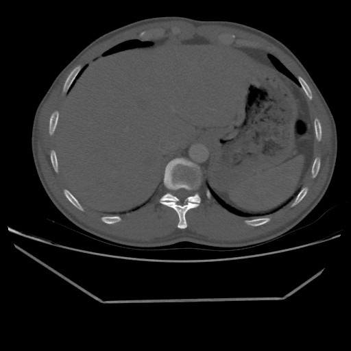 Aneurysmal bone cyst - rib (Radiopaedia 82167-96220 Axial bone window 222).jpg