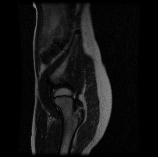 File:Aneurysmal bone cyst - sacrum (Radiopaedia 65190-74196 Sagittal T2 30).jpg