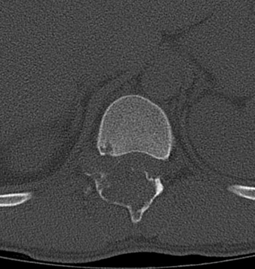 Aneurysmal bone cyst T11 (Radiopaedia 29294-29721 Axial bone window 45).jpg