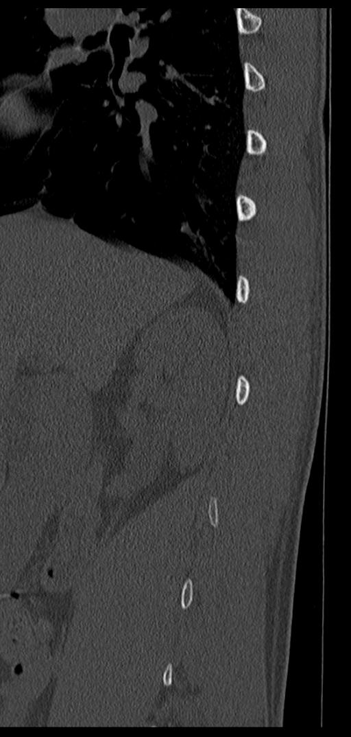 Aneurysmal bone cyst T11 (Radiopaedia 29294-29721 Sagittal bone window 67).jpg
