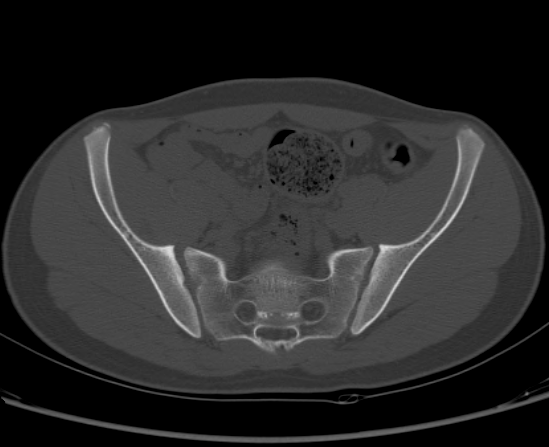 File:Aneurysmal bone cyst of ischium (Radiopaedia 25957-26094 Axial bone window 28).png