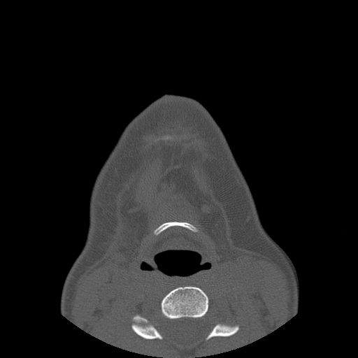 Aneurysmal bone cyst of the mandible (Radiopaedia 43280-46823 Axial bone window 2).jpg