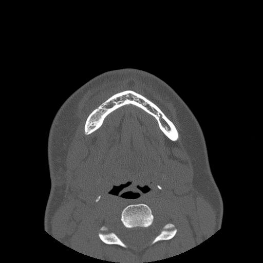 Aneurysmal bone cyst of the mandible (Radiopaedia 43280-46823 Axial bone window 27).jpg