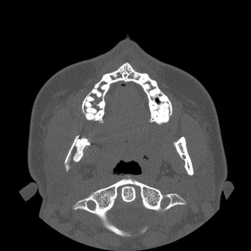 Aneurysmal bone cyst of the mandible (Radiopaedia 43280-46823 Axial bone window 89).jpg