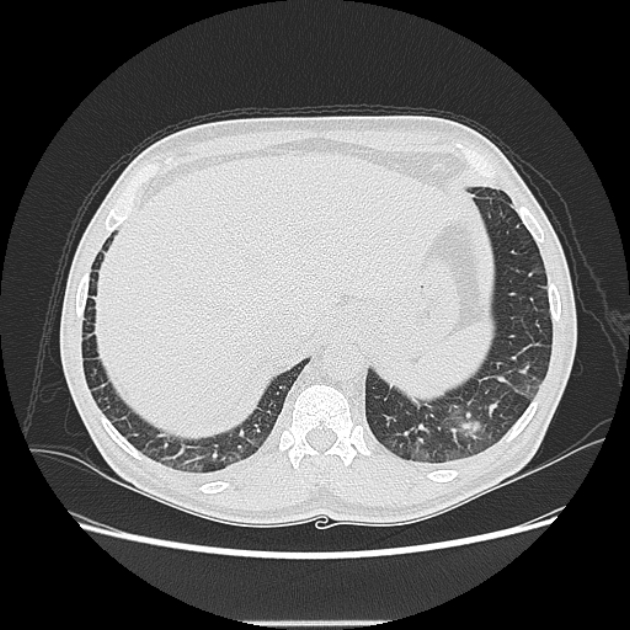 Angioinvasive aspergellosis (Radiopaedia 66995-76315 Axial lung window 46).jpg