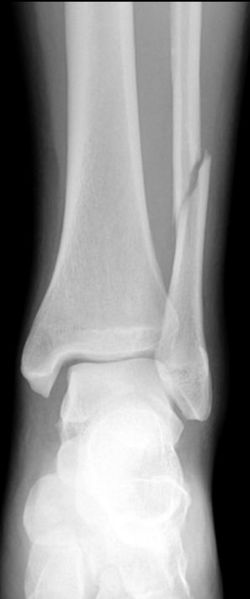 File:Ankle fracture - Weber C (Radiopaedia 12268-12568 Frontal 2).jpeg
