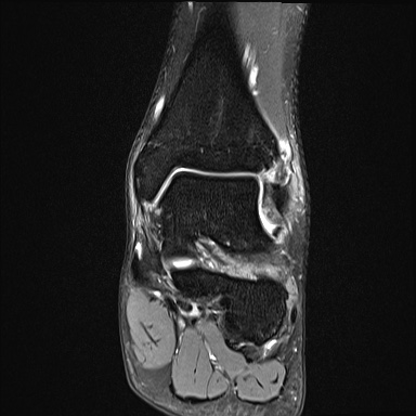 Ankle syndesmotic injury (Radiopaedia 69066-78837 Coronal PD fat sat 34).jpg