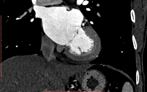 Anomalous left coronary artery from the pulmonary artery (ALCAPA) (Radiopaedia 70148-80181 B 184).jpg