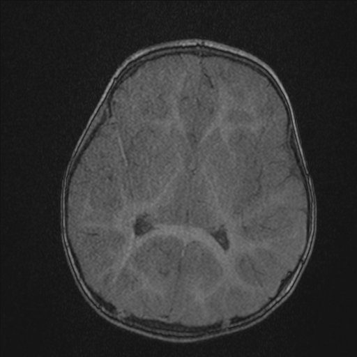 Anoxic brain injury (Radiopaedia 79165-92139 Axial MRA 129).jpg