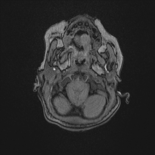Anoxic brain injury (Radiopaedia 79165-92139 Axial MRA 22).jpg