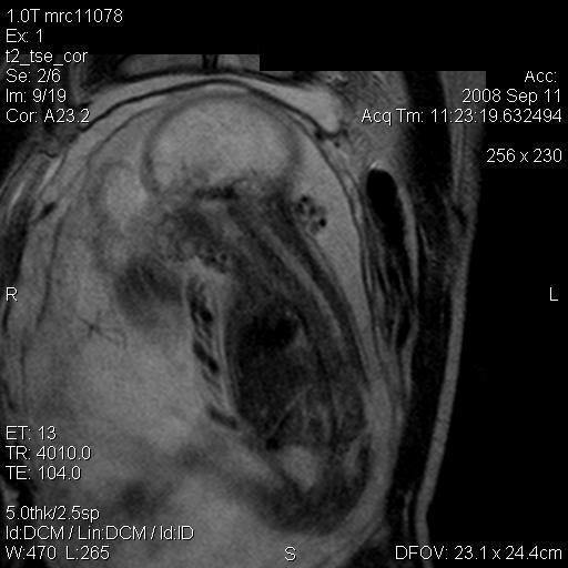 File:Antenatal MRI with meningocoele (Radiopaedia 5286-7036 C 1).jpg