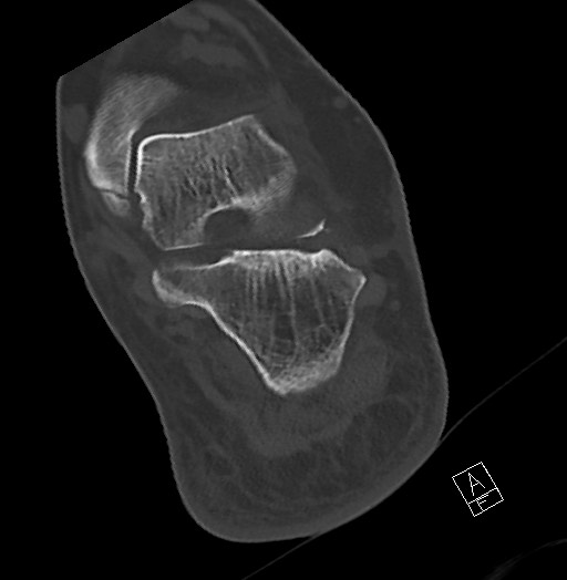 Anterior calcaneal process fracture (Radiopaedia 63353-71943 Axial bone window 101).jpg
