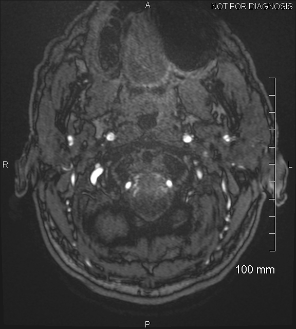 Anterior cerebral artery aneurysm (Radiopaedia 80683-94127 Axial MRA 1).jpg