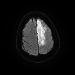 Anterior cerebral artery infarction (Radiopaedia 46794-51323 Axial DWI 23).jpg