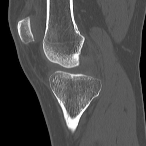 File:Anterior cruciate ligament avulsion fracture (Radiopaedia 58939-66194 Sagittal bone window 26).jpg