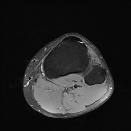 File:Anterior cruciate ligament full thickness tear (Radiopaedia 66268-75467 Axial PD fat sat 26).jpg
